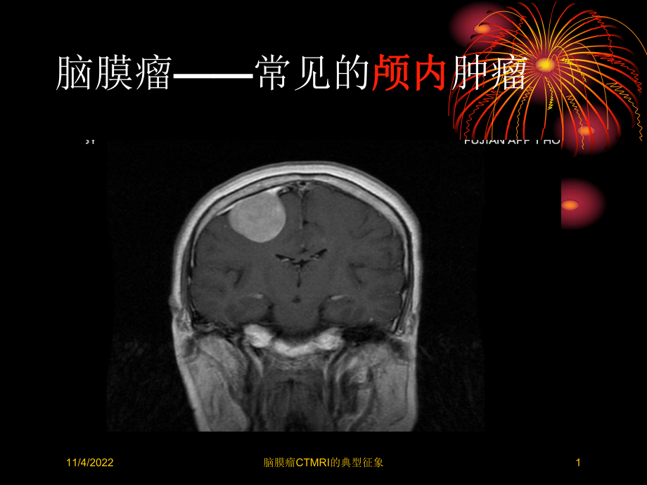 脑膜瘤CTMRI的典型征象培训课件.ppt_第1页