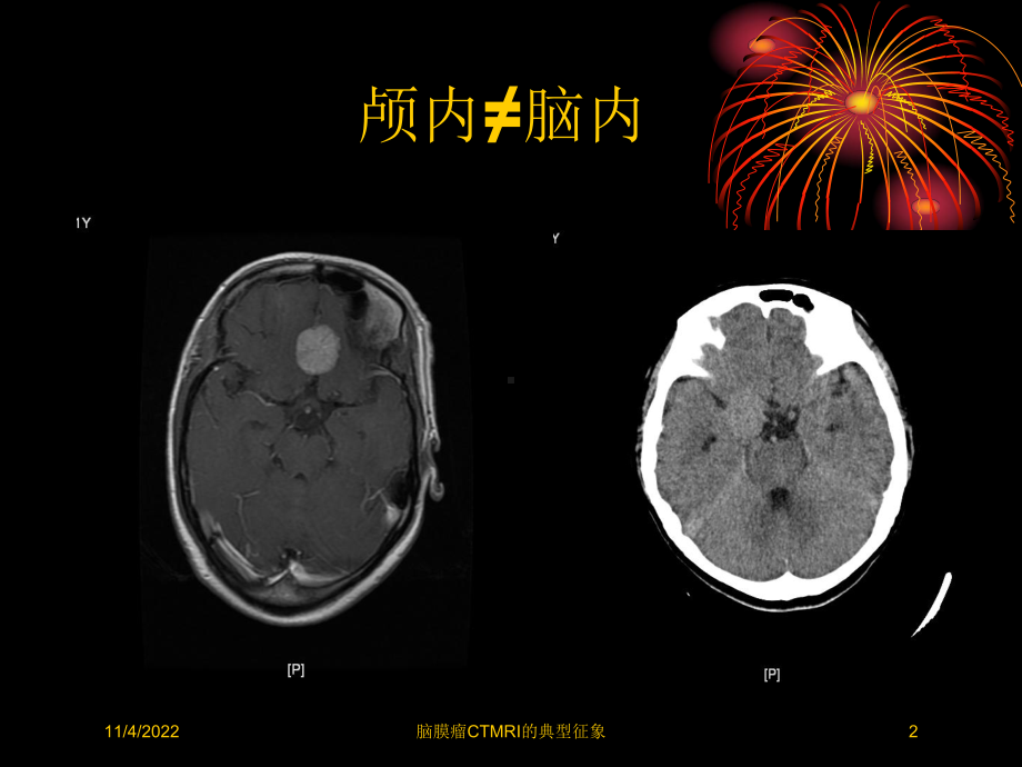 脑膜瘤CTMRI的典型征象培训课件.ppt_第2页