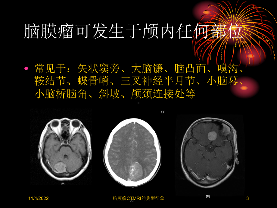 脑膜瘤CTMRI的典型征象培训课件.ppt_第3页