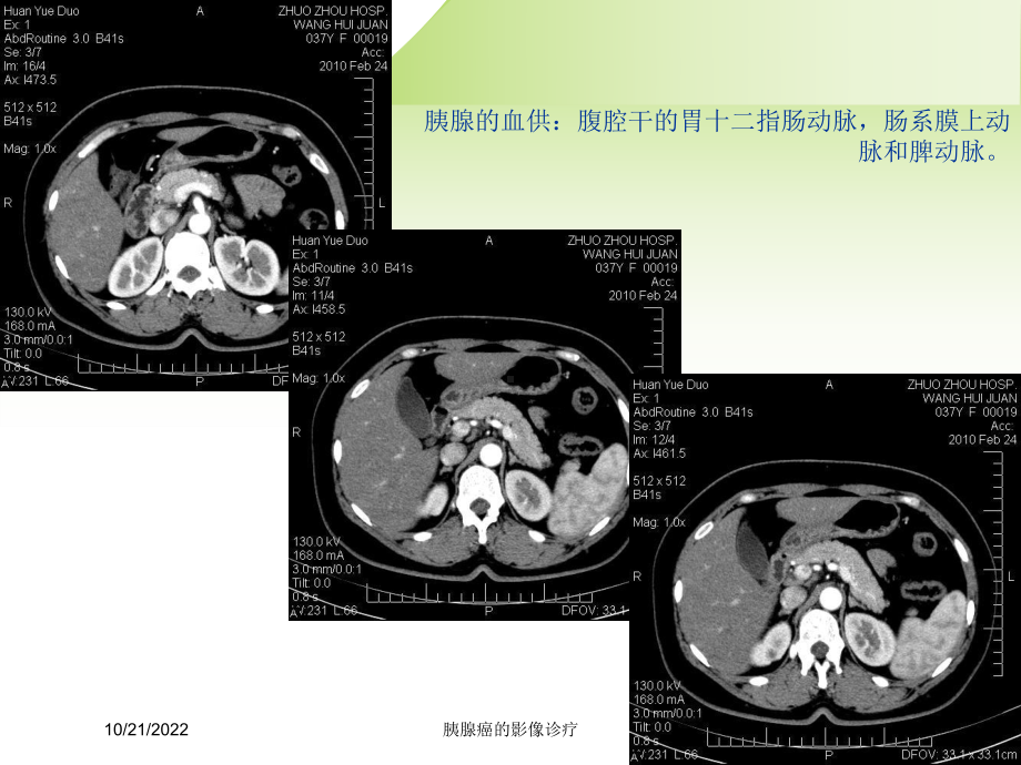 胰腺癌的影像诊疗培训课件.ppt_第2页