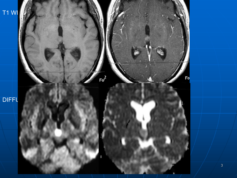 脑室肿瘤的诊断与鉴别诊断课件.ppt_第3页