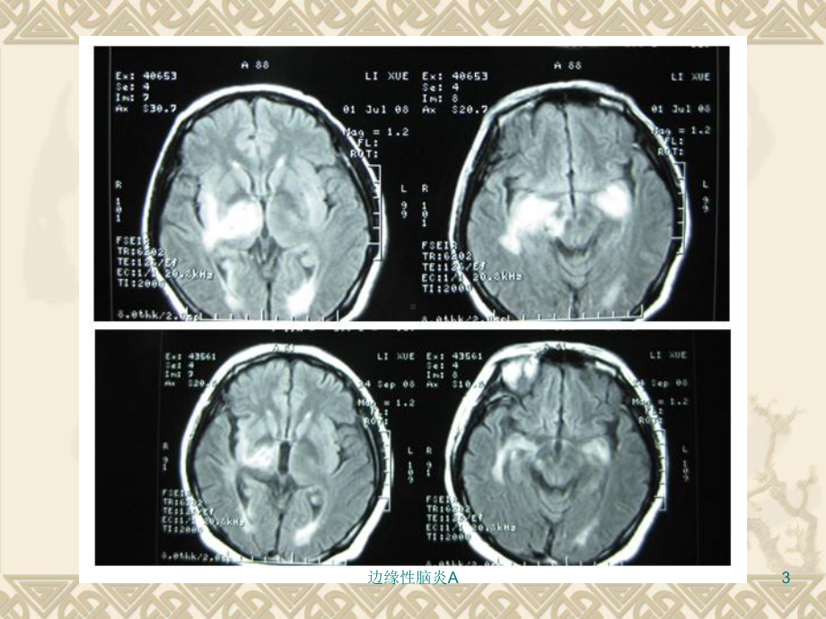 边缘性脑炎A课件.ppt_第3页