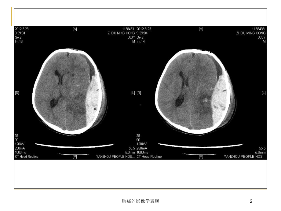 脑疝的影像学表现培训课件.ppt_第2页