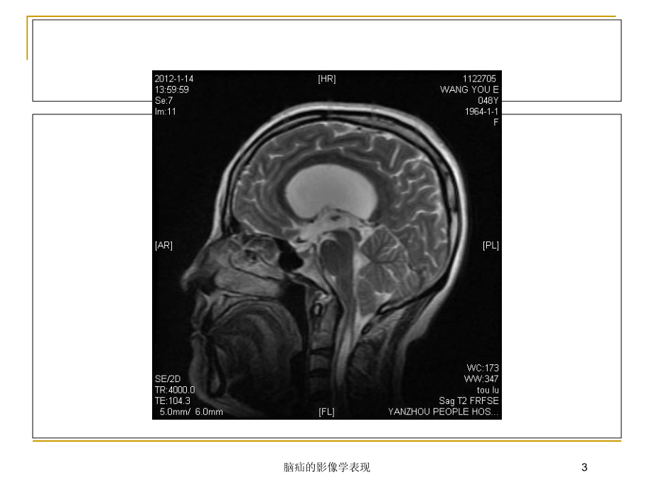 脑疝的影像学表现培训课件.ppt_第3页