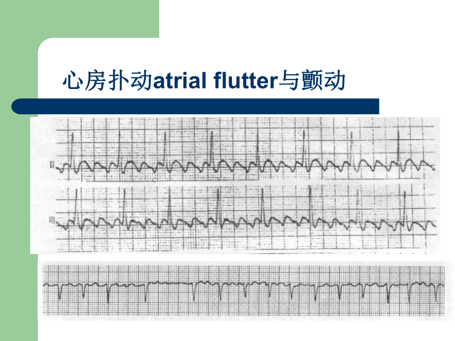 心电图基础知识-课件.ppt_第3页