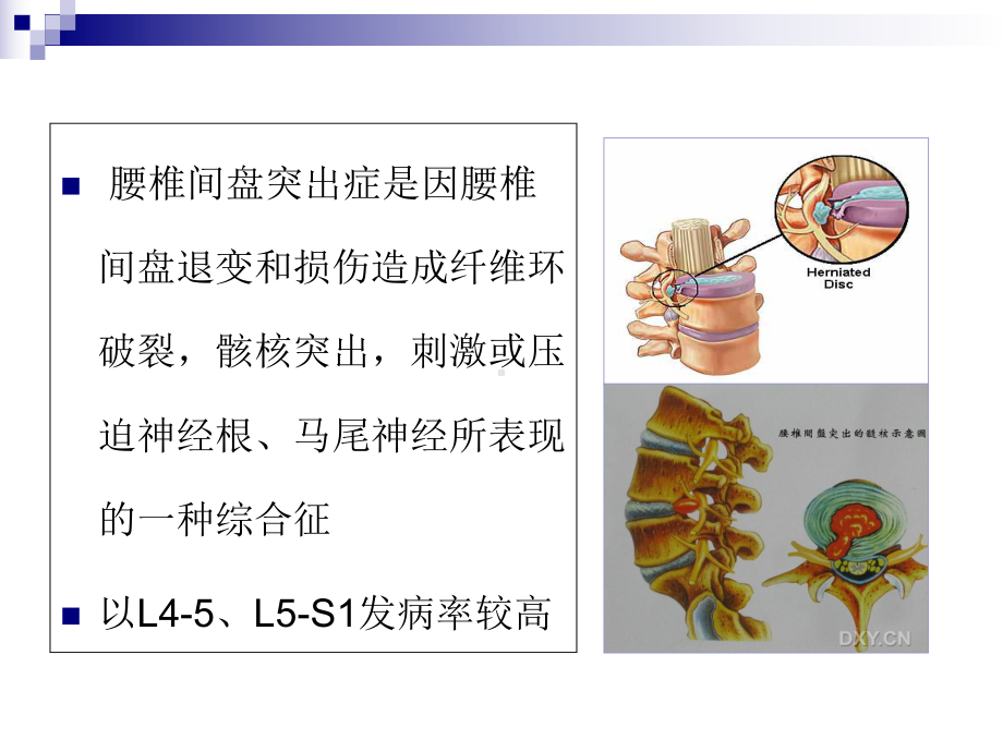 腰椎间盘微创介入治疗方法课件.ppt_第2页