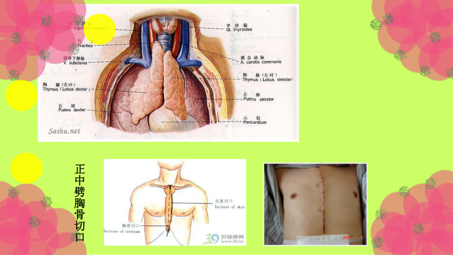 胸腺瘤护理查房课件2.ppt_第3页