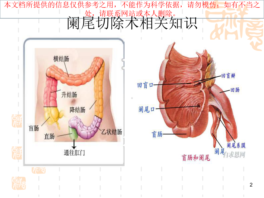 阑尾切除术相关知识和手术步骤培训课件.ppt_第2页