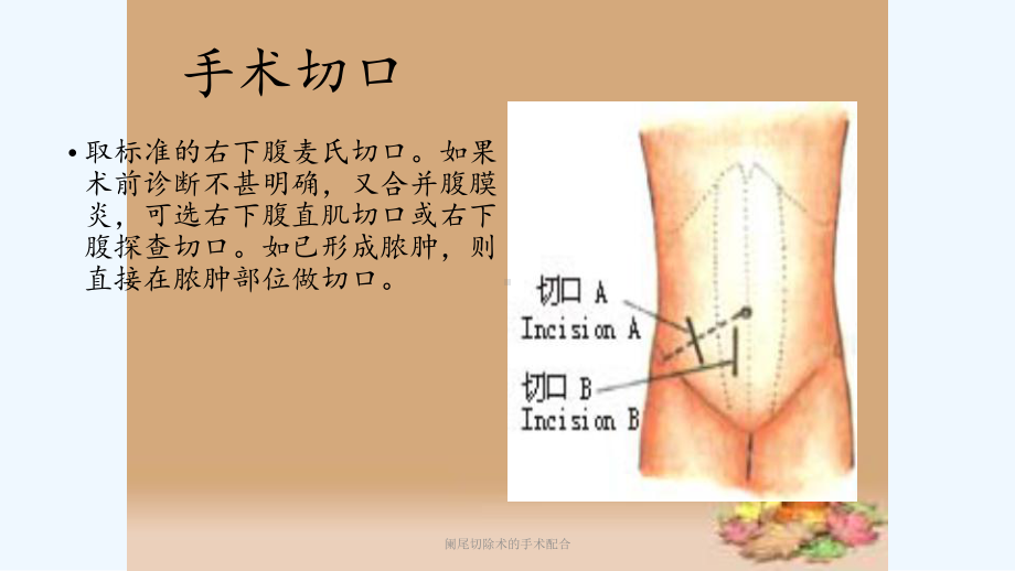 阑尾切除术的手术配合课件.pptx_第3页