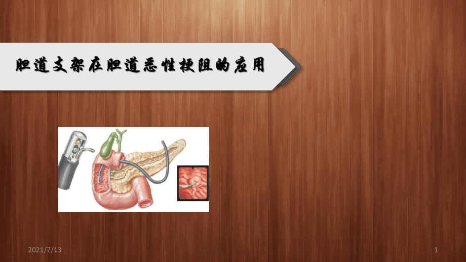 胆道支架在胆道恶性梗阻的应用课件.pptx_第1页