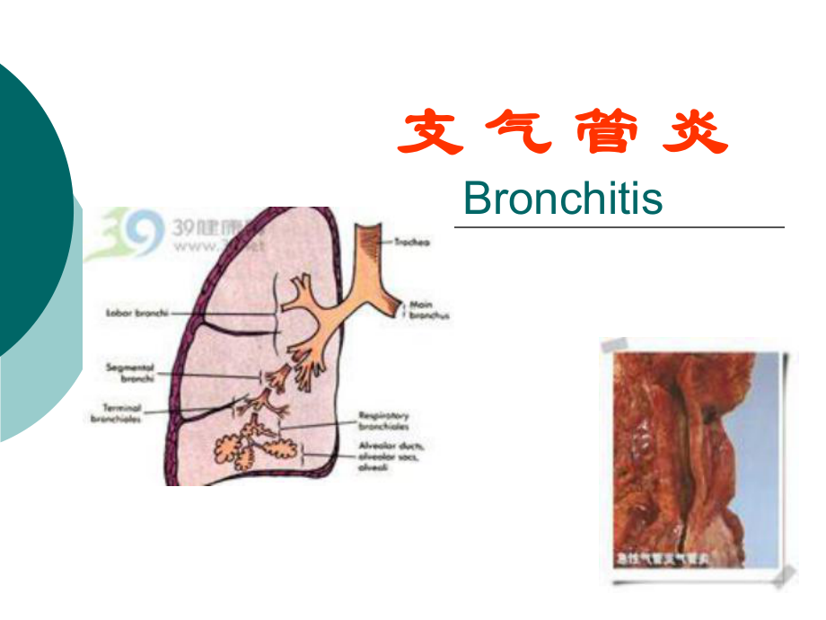 中医支气管炎课件.ppt_第1页