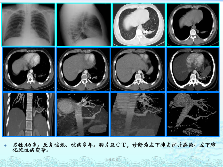 肺隔离症影像学-诊断(技术课堂)课件.ppt_第3页