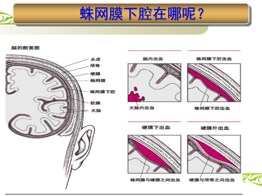 蛛网膜下腔出血课件88698.ppt_第3页