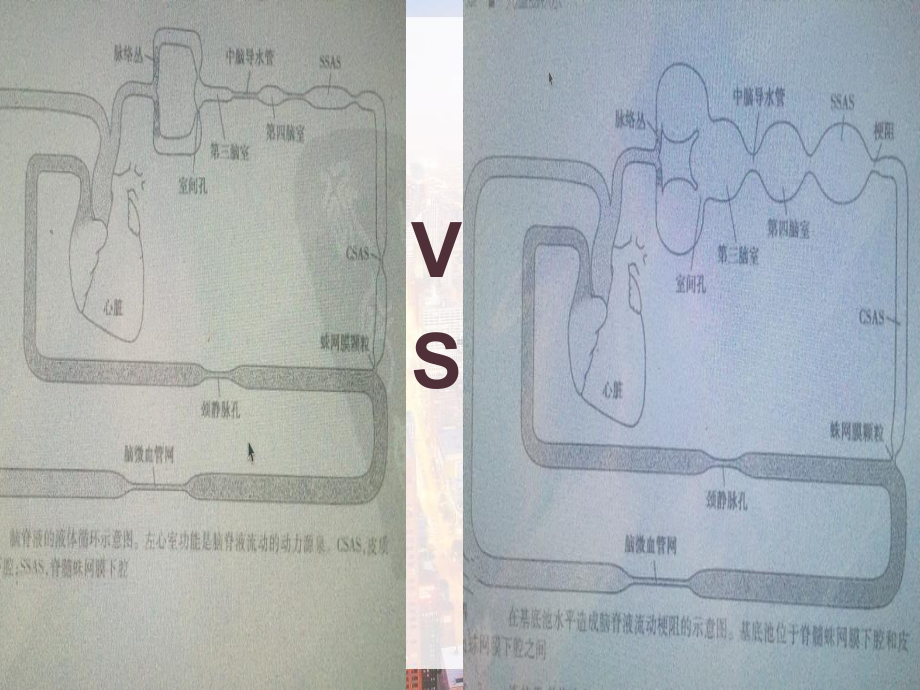 脑积水影像学特征-课件.pptx_第2页