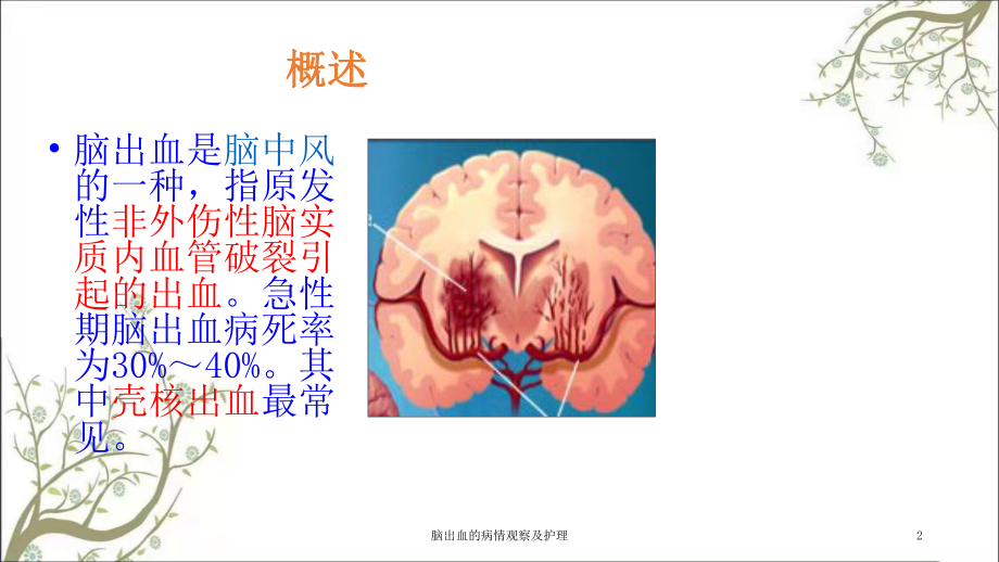 脑出血的病情观察及护理课件.ppt_第2页