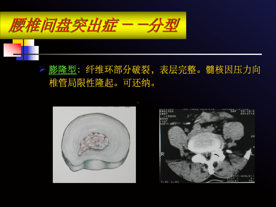 腰椎间盘突出症病人的护理课件-2.ppt_第3页