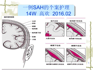 蛛网膜下腔出血的个案护理课件-2.ppt