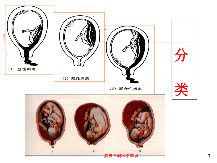 胎盘早剥医学知识培训课件.ppt_第3页