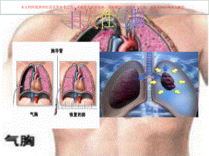 自发性气胸专业知识讲座培训课件.ppt