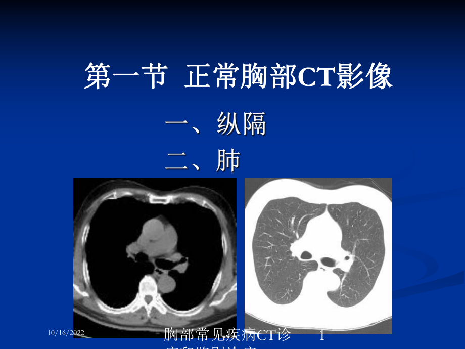 胸部常见疾病CT诊疗和鉴别诊疗培训课件.ppt_第1页