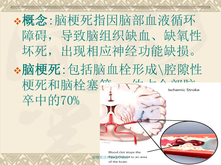 脑梗死诊疗影像学治疗培训课件.ppt_第2页