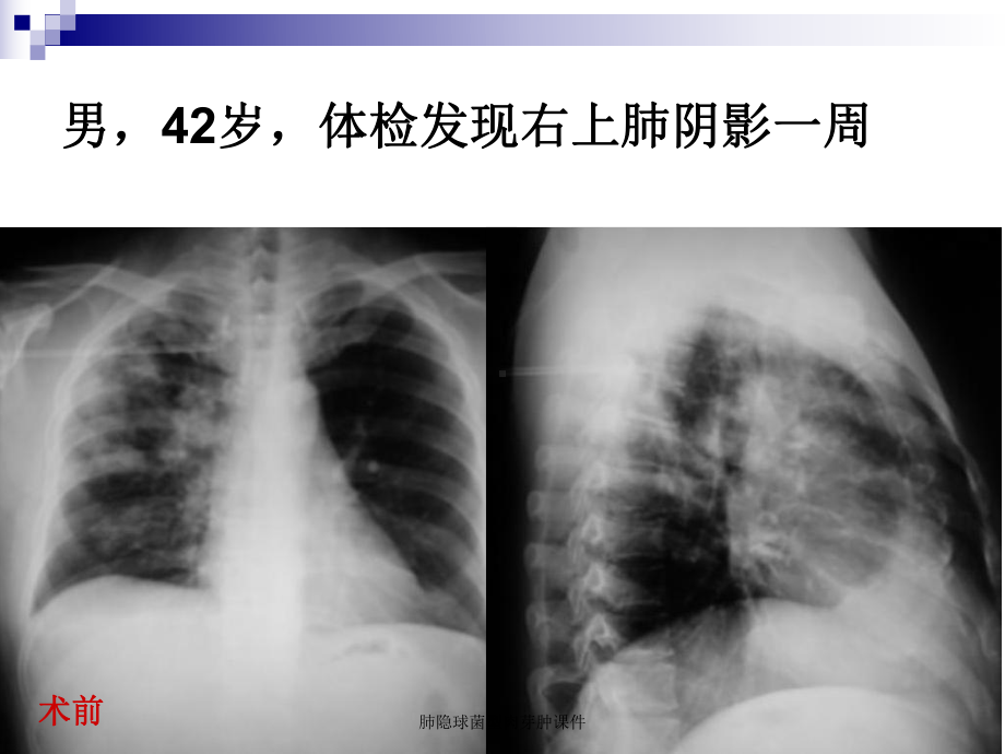 肺隐球菌型肉芽肿课件.ppt_第2页