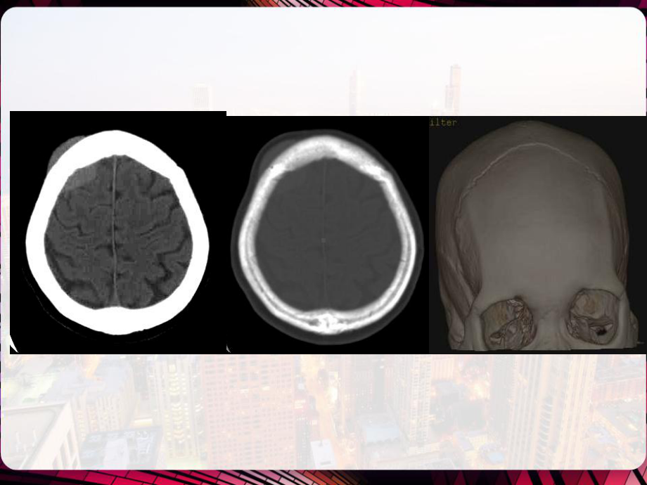 颅内原发性淋巴瘤CTMR诊断与鉴别诊断-课件.pptx_第2页