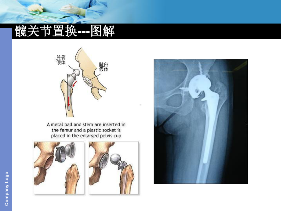 人工关节置换手术护理配合课件.ppt_第3页