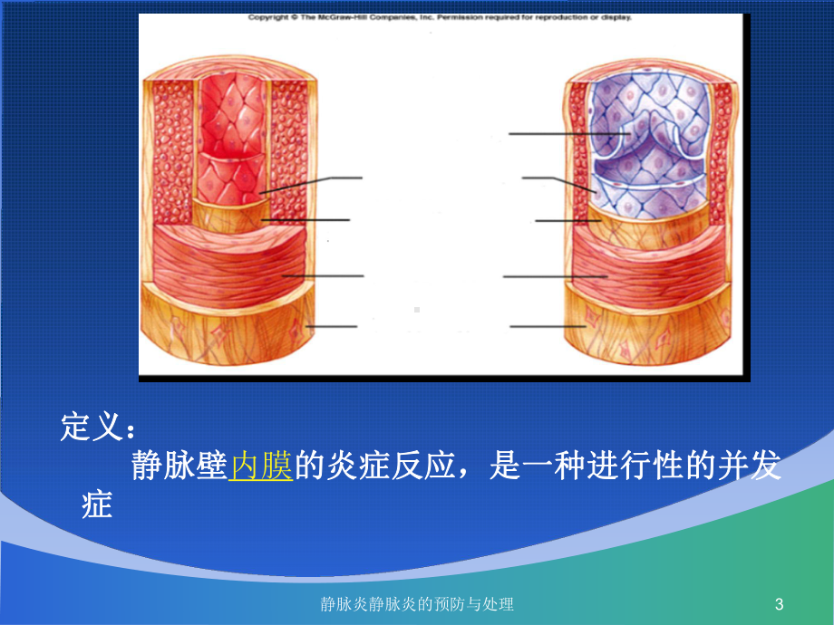 静脉炎静脉炎的预防与处理培训课件.ppt_第3页