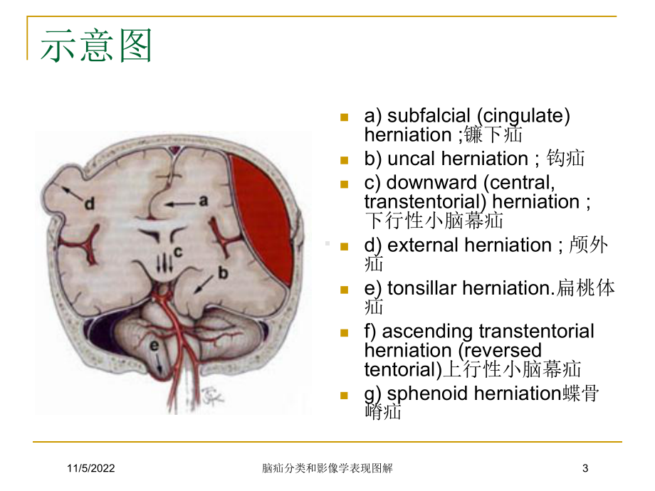 脑疝分类和影像学表现图解培训课件.ppt_第3页