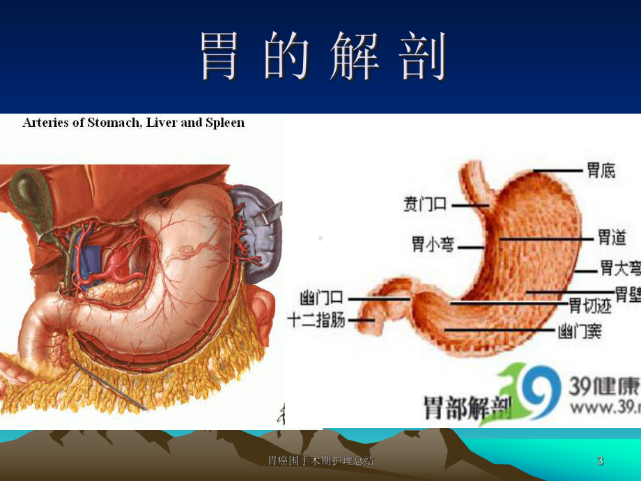 胃癌围手术期护理总结培训课件.ppt_第3页