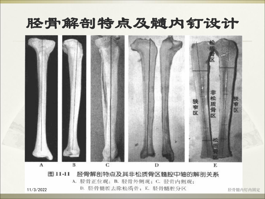 胫骨髓内钉内固定培训课件.ppt_第1页