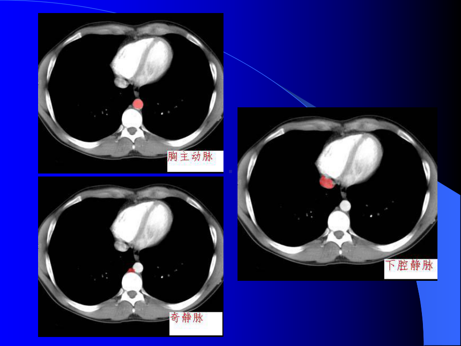 腹部CT诊断-课件.ppt_第3页