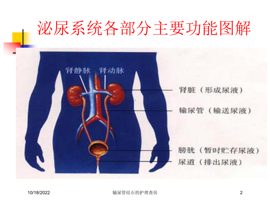 输尿管结石的护理查房培训课件.ppt_第2页