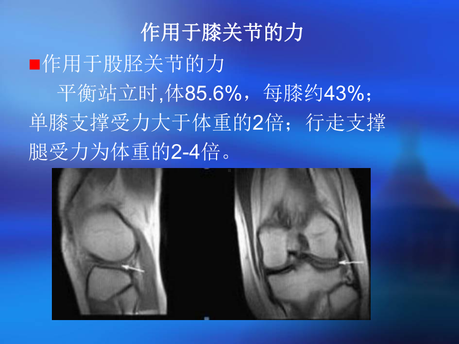 膝关节骨性关节炎健康教育讲座汇编课件.ppt_第3页