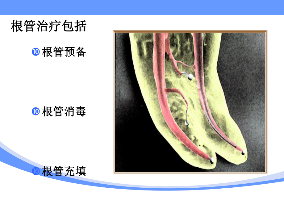 现代根管治疗新技术-课件.ppt_第2页