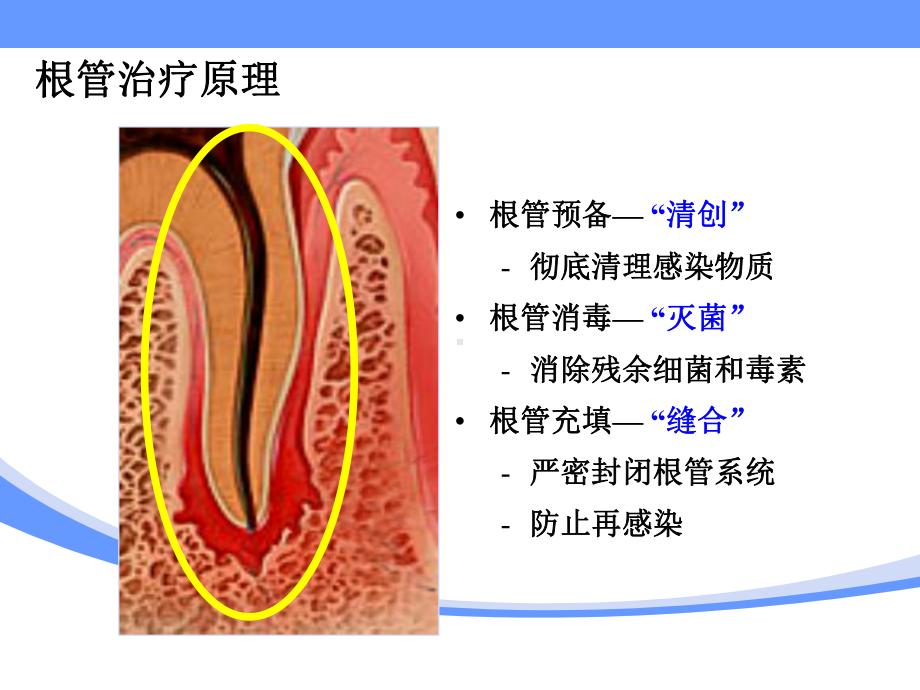 现代根管治疗新技术-课件.ppt_第3页