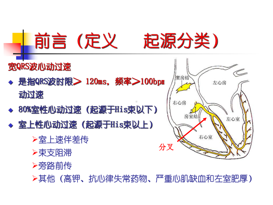 宽QRS波心动过速的鉴别课件.ppt_第2页