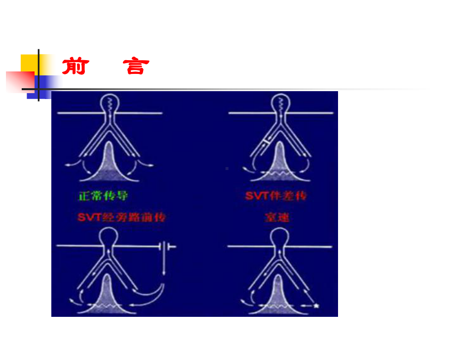 宽QRS波心动过速的鉴别课件.ppt_第3页