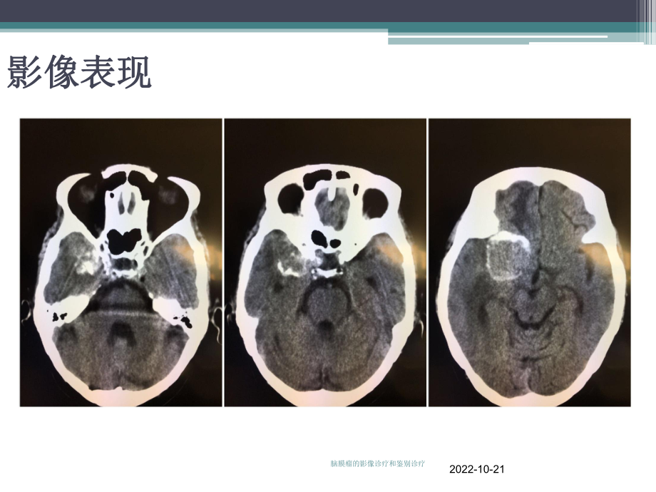 脑膜瘤的影像诊疗和鉴别诊疗培训课件.ppt_第1页