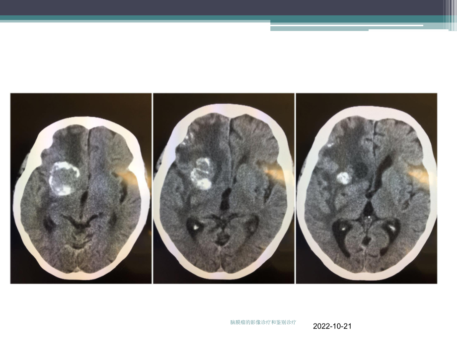 脑膜瘤的影像诊疗和鉴别诊疗培训课件.ppt_第2页