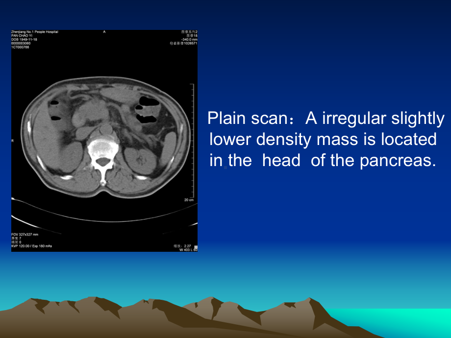 胰腺癌影像学表现英语读片课件.ppt_第3页