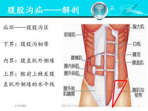 腹股沟疝专业知识宣讲培训课件.ppt