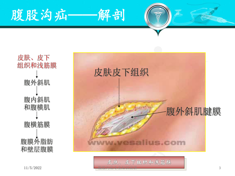 腹股沟疝专业知识宣讲培训课件.ppt_第3页