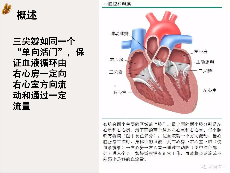 胸腔镜三尖瓣置换术后护理查房1课件.ppt_第3页