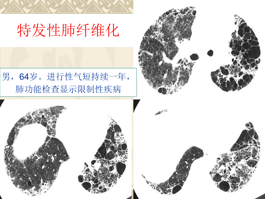 肺部弥漫性病变的HRCT诊断(低密度影部分)课件.ppt_第3页