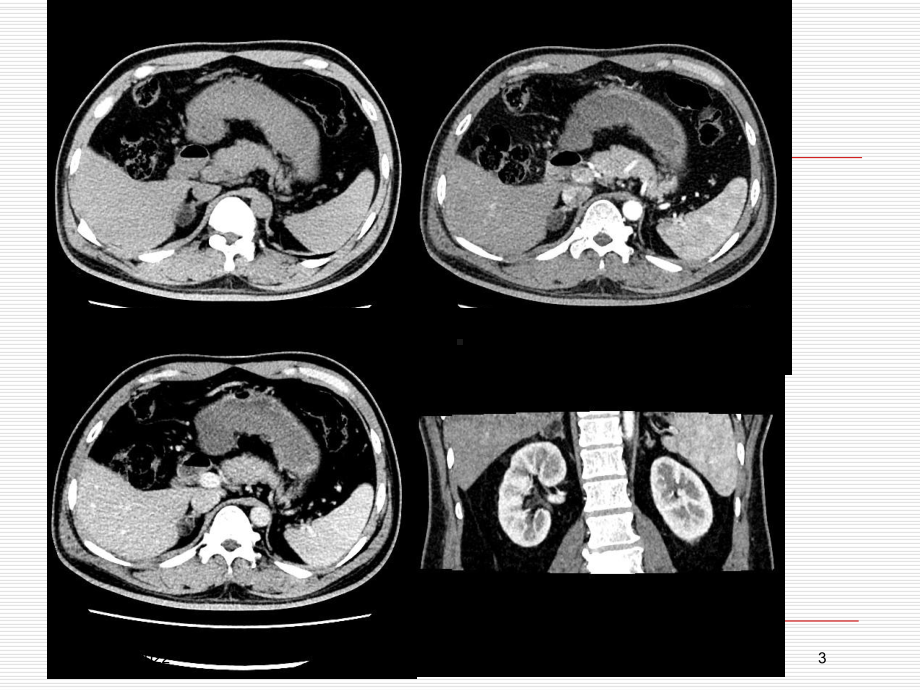肾上腺含脂肪密度病变的CT诊疗培训课件.ppt_第3页