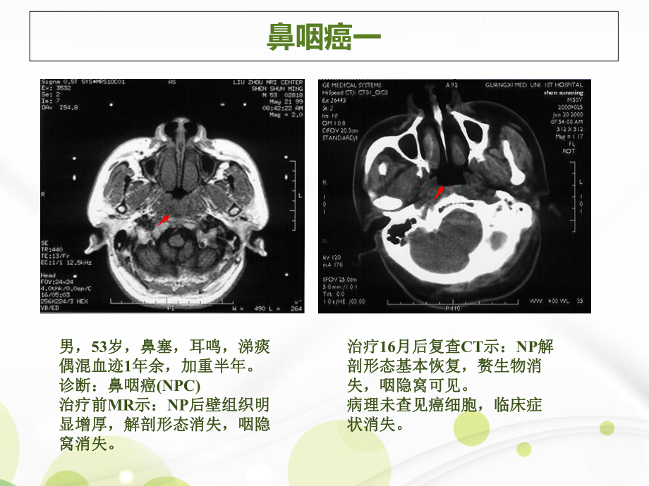 肿瘤各病种病例课件.ppt_第2页