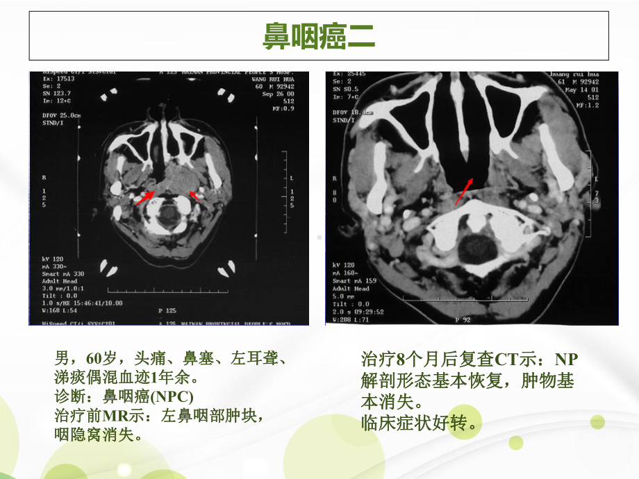 肿瘤各病种病例课件.ppt_第3页