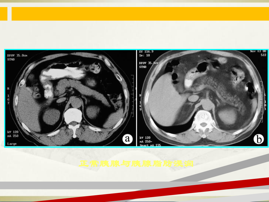 胰腺常见病变的CT诊断课件.ppt_第3页